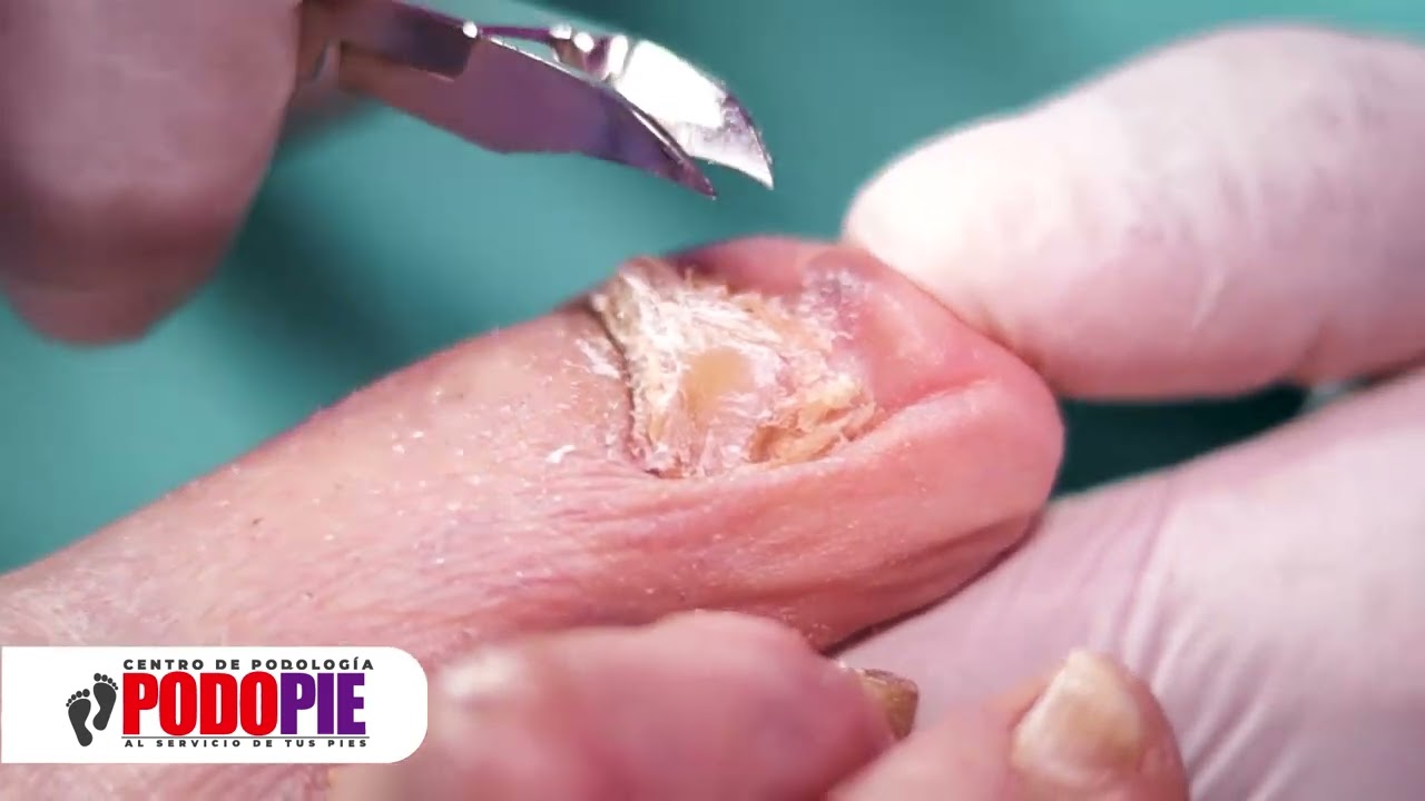 Limpieza de Hongos ONICOMICOSIS