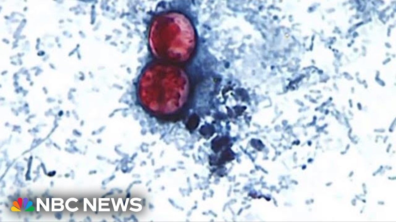 Video: CDC tracks record cyclospora outbreak as states report thousands of cases