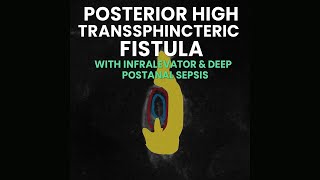Posterior High Transsphincteric Fistula with Abscess | PILTEC Sphincter-Preserving Surgery