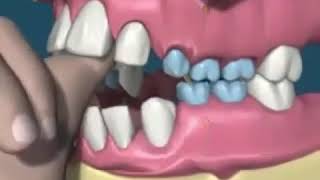 Teeth misalignment due to thumb sucking