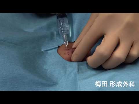 粉瘤（アテローム）の手術動画｜大阪梅田形成外科粉瘤クリニック