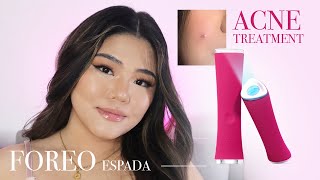 HOW TO GET RID OF PIMPLES ASAP | FOREO ESPADA REVIEW