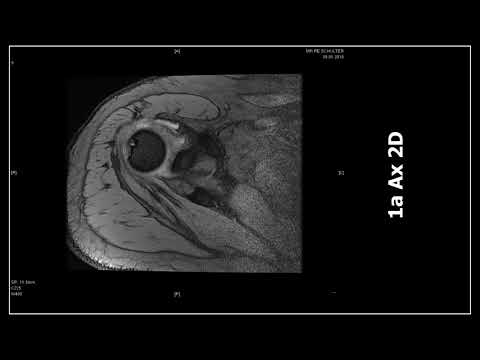 Was ist degenerative dystrophischen Veränderungen in der Brust Wund Taille und Prostata