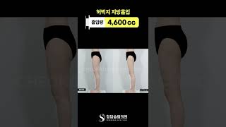 허벅지 지방흡입했는데, 키 커보임