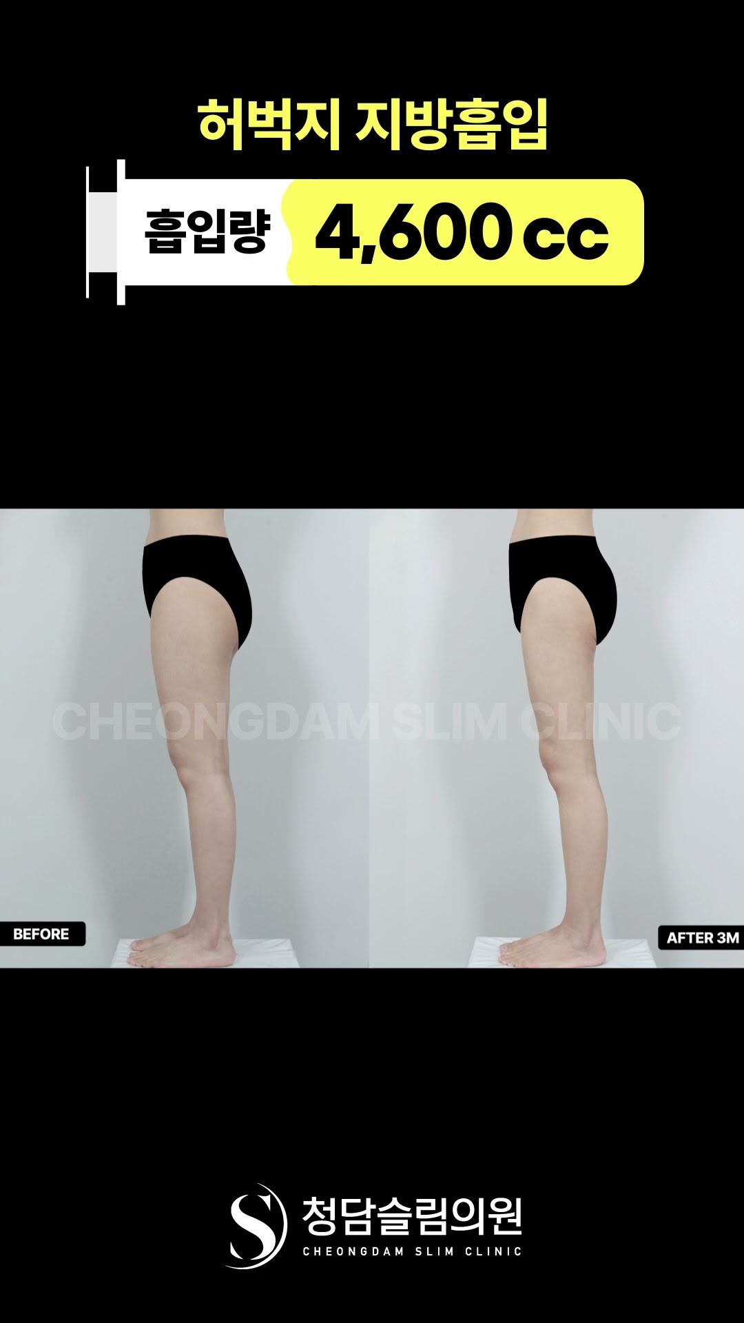 허벅지 지방흡입했는데, 키 커보임