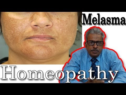 Melasma (chloasma) Remedy in Homeopathy by Dr. P.S. Tiwari Melasma (chloasma) Remedy in Homeopathy by Dr. P.S. Tiwari