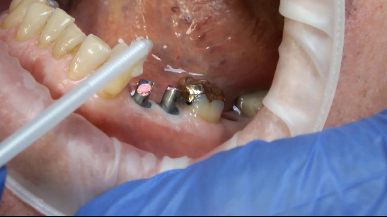 Reverse Margin Prosthetic Implant