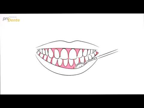 Professionelle Zahnreinigung - Erklärvideo