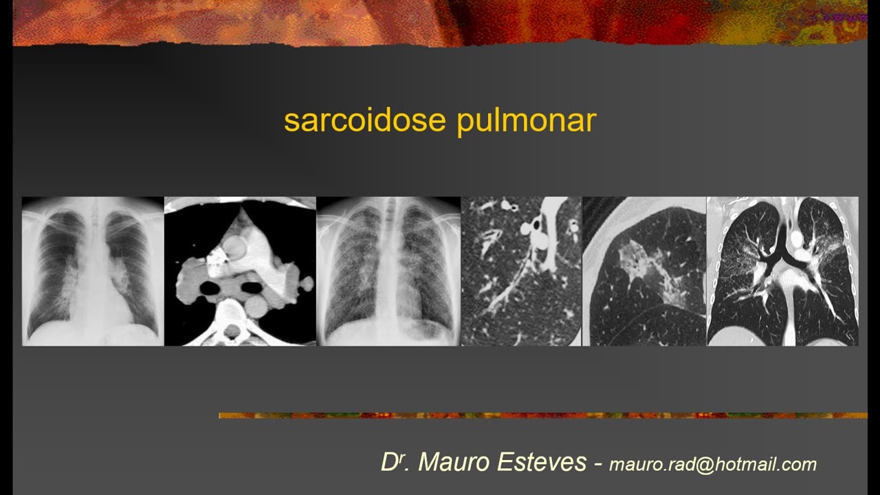 Sarcoidose pulmonar