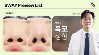 NOSE PREVIEW. 복코 원인과 결과 케이스 파헤치기 | #콧볼축소
