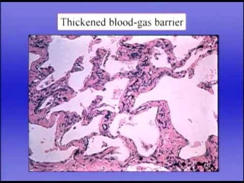 Pulmonary Function Test