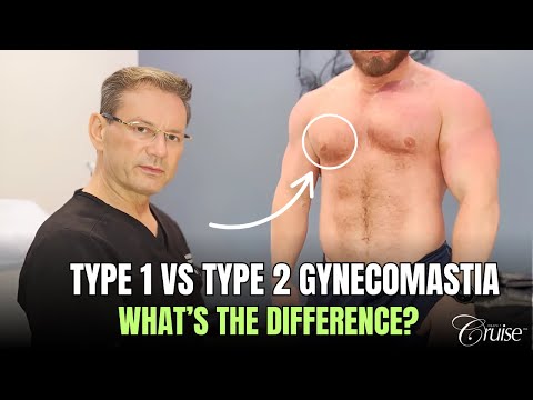 Diagnosing Gynecomastia. Type 1 & 2