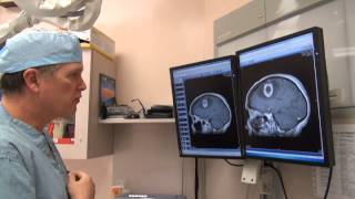 Brain Surgery with Dr. Mark Matishak - 02 MRI scan with tumour