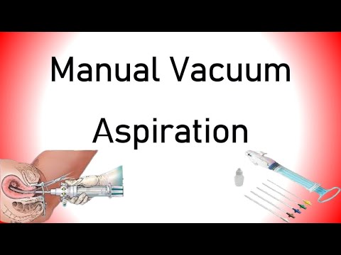 Manual Vacuum Aspiration (MVA)