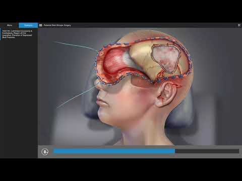 Traumatic Brain Injury - Brain Surgery Animation