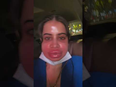 Omg 😳 Urfi Javed Lip Fillers 💋 #urfijaved #bollywood #trending #viralvideo #shorts