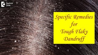 FLAKY SCALP DANDRUFF not cleared by Home Remedies. What to do? - Dr. Amee Daxini | Doctors
