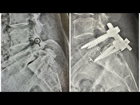 TLIF surgery for Spine Spondylolisthesis | Dr. Ajay Kothari