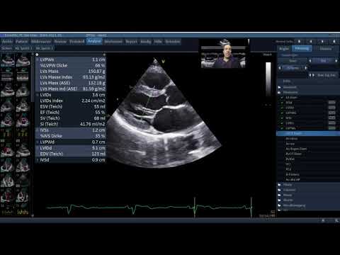 Standardisierte Echokardiographie - Normalbefund