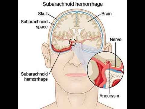 Subarachnoid Hemorrhage