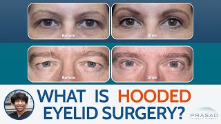 What is Surgery for Hooded Eyelids?