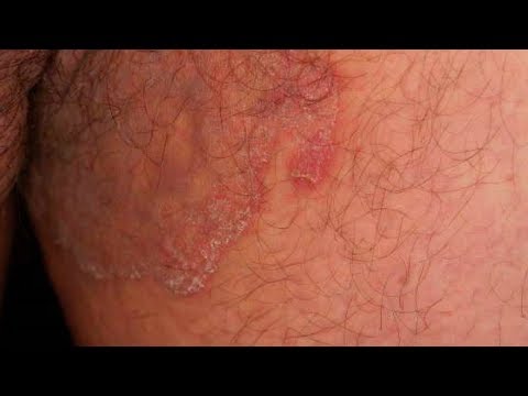 Kung paano ituring ang fungus sa kanyang mga kamay Itraconazole may paa halamang-singaw