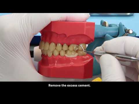 RelyX U 200 cementation on zirconia crown