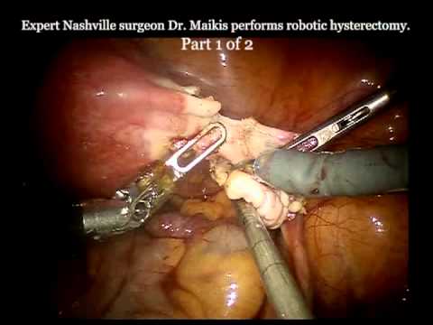 Total Laparoscoic Hysterectomy | Dr. Roseann Maikis, M.D., F.A.C.O.G. | Obstetrician and Gynecologist in Nashville, TN
