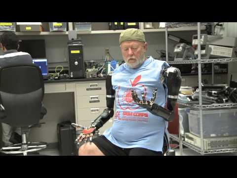 Amputee Controls Both Bionic Arms