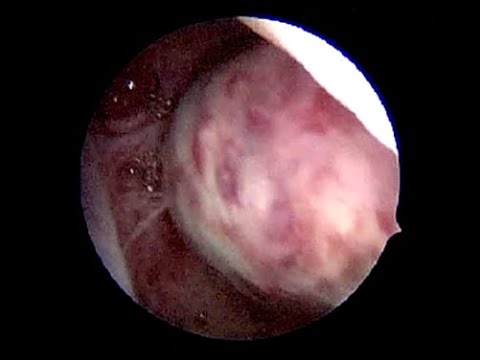 Embarazo intrauterino con un fibroma grande