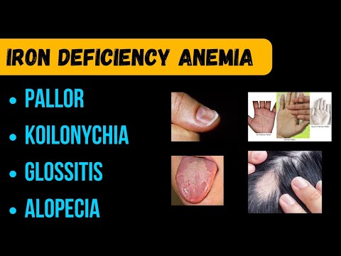 Iron Deficiency Anemia | Causes, Symptoms, and Treatment Explained