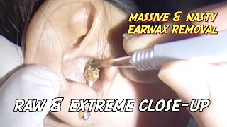 Massive &amp; Nasty Earwax Removal- Raw &amp; Extreme Close-up Version