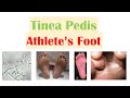 Athlete’s Foot (Tinea Pedis)| Causes, Risk Factors, Signs & Symptoms, Diagnosis and Treatment