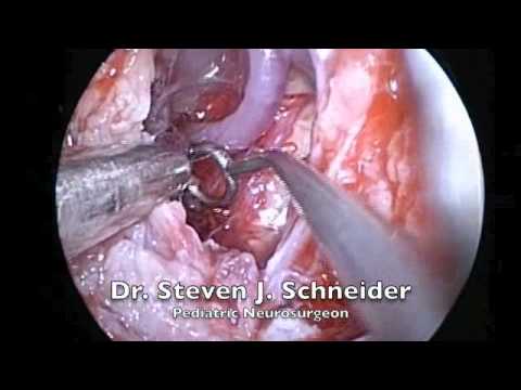 Brainstem Decompression by the Use of Endoscopic Transnasal and Intraoral Approach