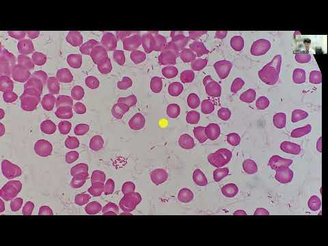 看護学科 今日のグラム染色この1枚 Pseudomonas aeruginosa ～血液培養の細長いグラム陰性桿菌～