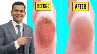 fix cracked heels fast | homemade cream to treat cracked heels naturally