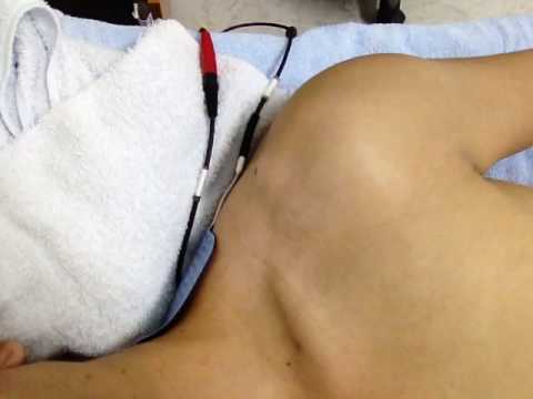 รักษาเขาของความอ่อนแอ สมาชิกใน tubercles ขนาดเล็ก