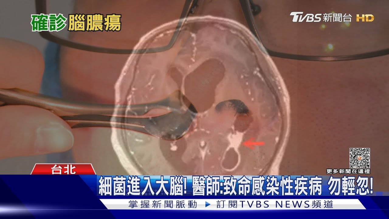 疏忽這件事 細菌透過血液進入腦部引發感染 醫師:致命感染性疾病!