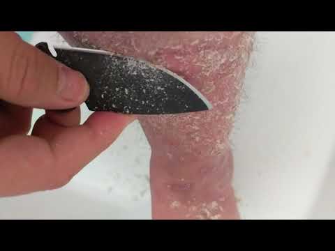 Das Ekzem in der Leiste die Symptome Die Salbe für die Behandlung der Nägel bei der Schuppenflechte