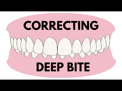 Management of Deep Bite -Orthodontics