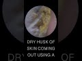 DRY EAR WAX HUSK REMOVAL
