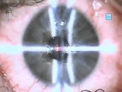 Neurológus gyenge látás