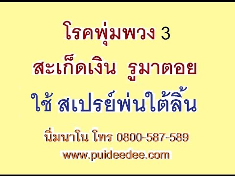มือกลากเรื้อรัง Vesta โรคผิวหนังภูมิแพ้