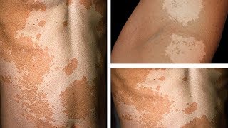 How to Get Rid of Tinea Versicolor Permanently || 8 Home Remedies for Tinea Versicolor On Back/Face