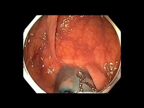 Colonoscopia - lesión sutil en la flexión hepática 