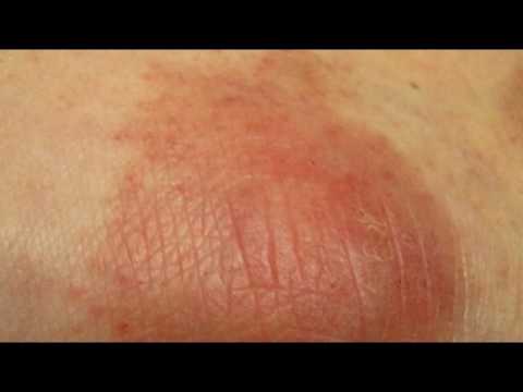 Как и чем лечить пигментные пятна на лице Как уксусом избавиться от пигментных пятен