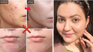 मुश्किल से मुश्किल मुंहासे PIMPLES, ACTIVE ACNE, Dark Spots का करें 100% इलाज और पाएं बेदाग Skin