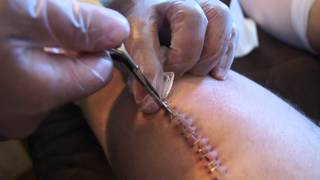 Staple removal from knee surgery