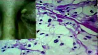 Dr.Sahar - apoptosis and intracellular accumlation - Pathology