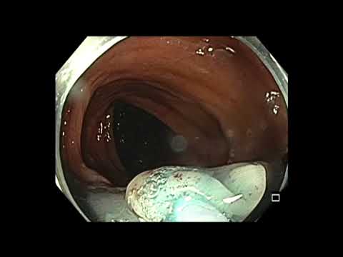 Coloscopie : petite lésion plate du côlon transverse - mucosectomie endoscopique à l’anse froide